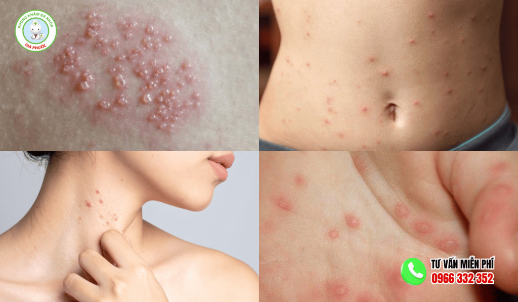 Nguyên nhân nổi mụn nước không ngứa
