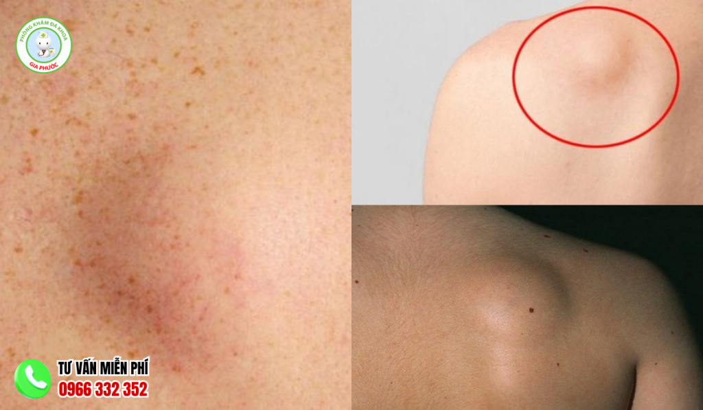 Nổi cục cứng dưới da không đau