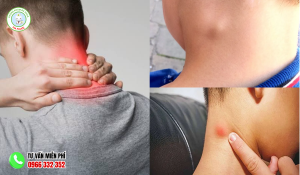 Hình ảnh nổi cục sau gáy không đau