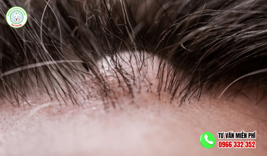 Hình ảnh nổi cục u trên đầu không đau