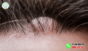 Hình ảnh nổi cục u trên đầu không đau