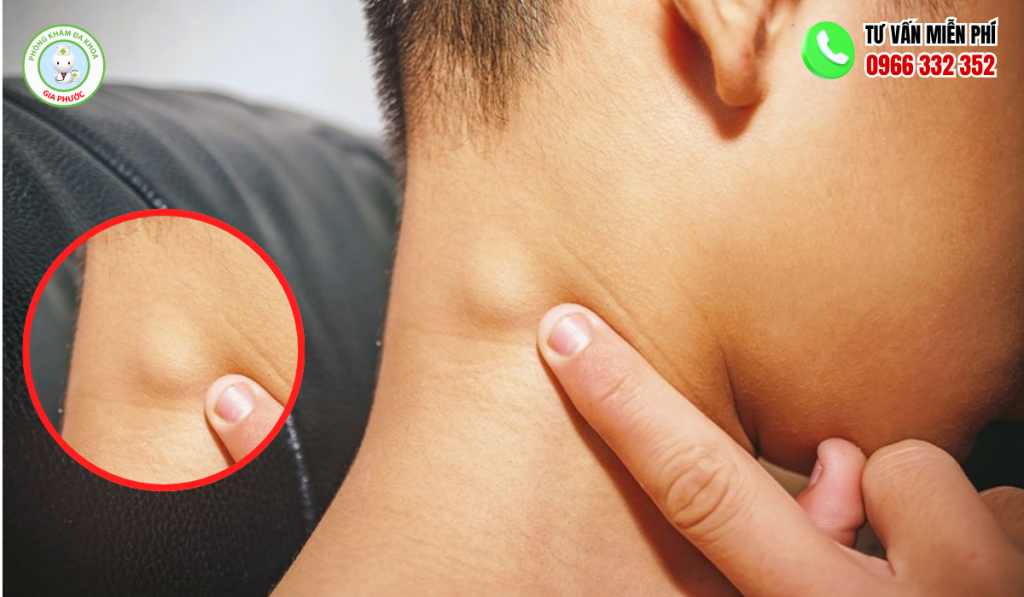 Hình ảnh nổi hạch sau tai