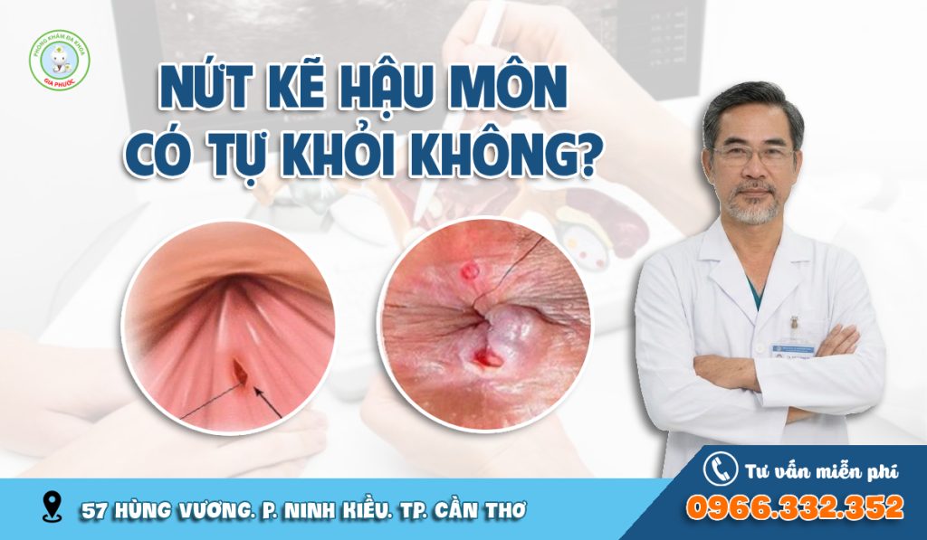 Nứt kẽ hậu môn có tự khỏi được không