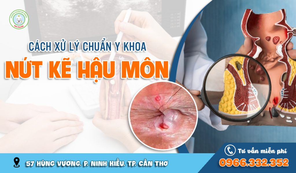 Nứt kẽ hậu môn phải làm sao?