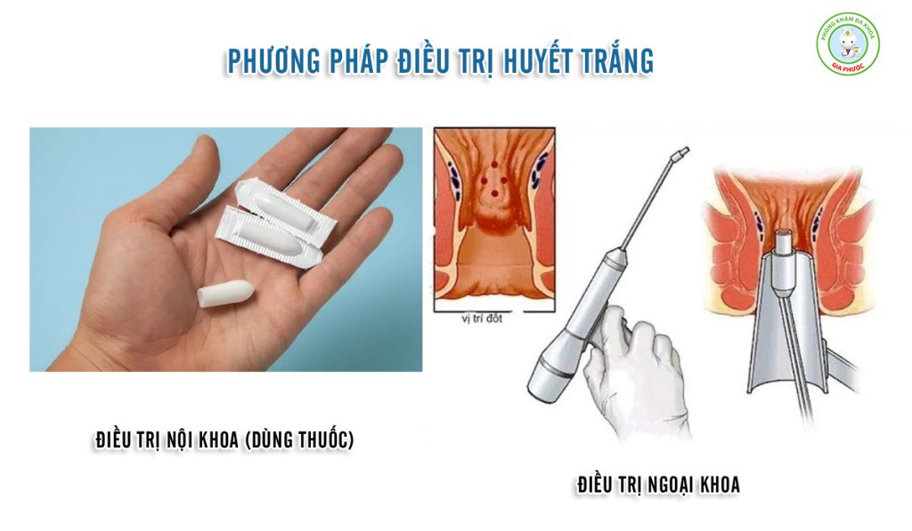 Cách chữa dứt điểm bệnh huyết trắng