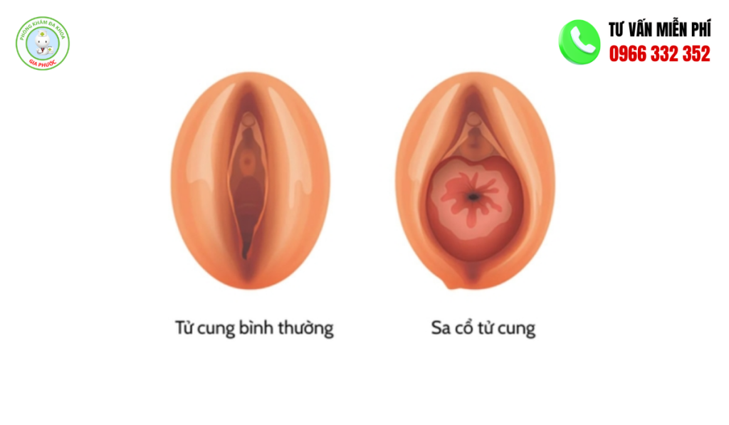 Hình Ảnh Sa Tử Cung Độ 2: Nhận Biết, Cách Trị Hiệu Quả 2 Hình Ảnh Sa Tử Cung Độ 2