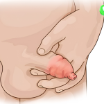 Sưng bao quy đầu