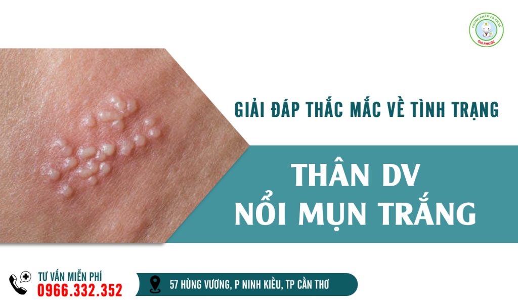 Thân dương vật nổi mụn trắng phải làm sao?