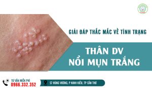 Thân dương vật nổi mụn trắng phải làm sao?
