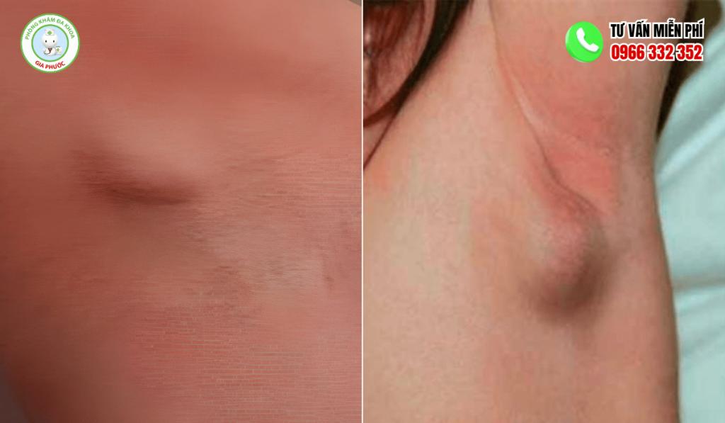 Tổng hợp hình ảnh u bã đậu ở nách