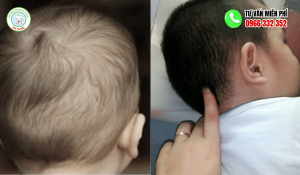Trẻ nổi hạch sau đầu