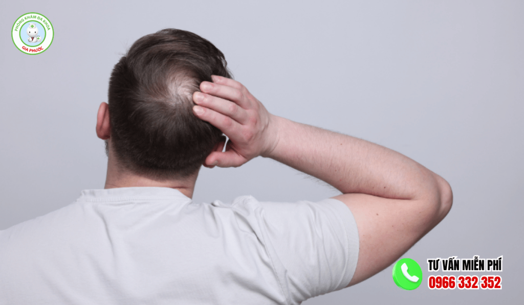 Tự nhiên nổi cục u trên đầu không đau 