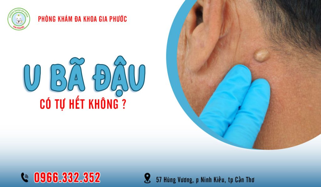 U bã đậu có tự hết không?