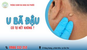 U bã đậu có tự hết không?