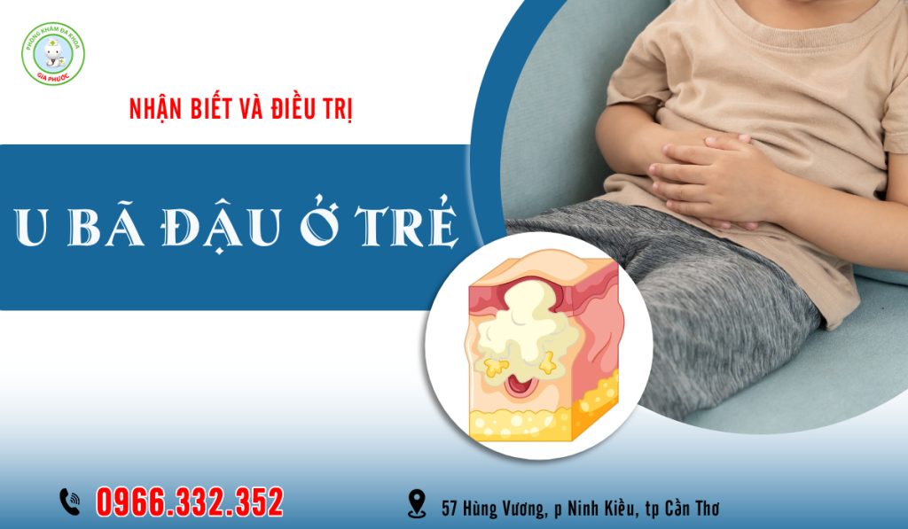 U Bã Đậu Ở Bộ Phận Sinh Dục Trẻ Nhỏ: Dấu Hiệu, Nguy Hiểm & Cách Xử Lý An Toàn 1 u bã đậu ở bộ phận sinh dục trẻ nhỏ