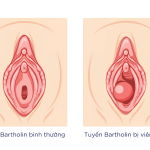 Viêm tuyên bartholin