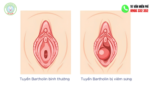Viêm tuyên bartholin