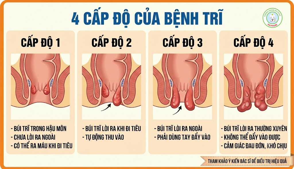 Búi Trĩ Có Tự Teo Lại Không? Giải Đáp Chuẩn Y Khoa 2 Phân độ bệnh trĩ từ nhẹ đến nặng