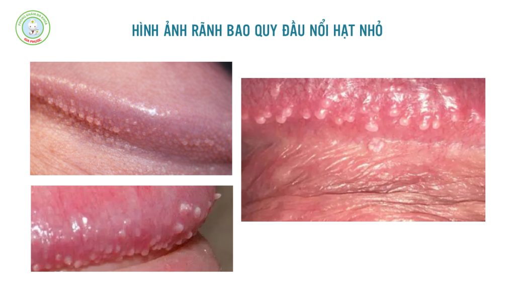 Rãnh Bao Quy Đầu Nổi Hạt Nhỏ Bệnh Gì? Cách Xử Lý Hiệu Quả Chuẩn Y Khoa 2 Hình ảnh rãnh bao quy đầu nổi hạt nhỏ