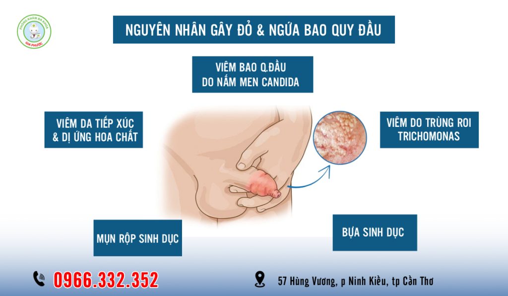 5 Nguyên nhân gây đỏ và ngứa bao quy đầu ở nam giới