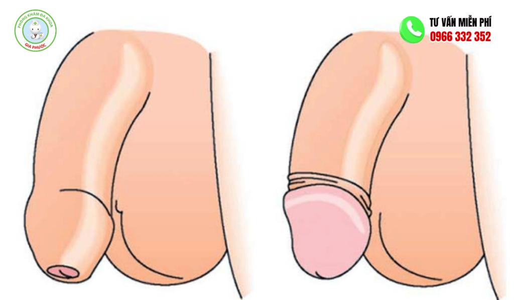 Bao quy đầu dài có cần cắt không