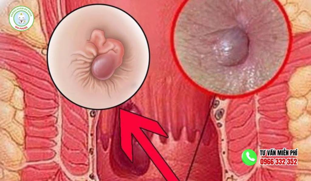 Bệnh Lòi Dom Là Gì? Hình Ảnh, Có Tự Khỏi Không Và Cách Chữa 1 Bệnh lòi dom