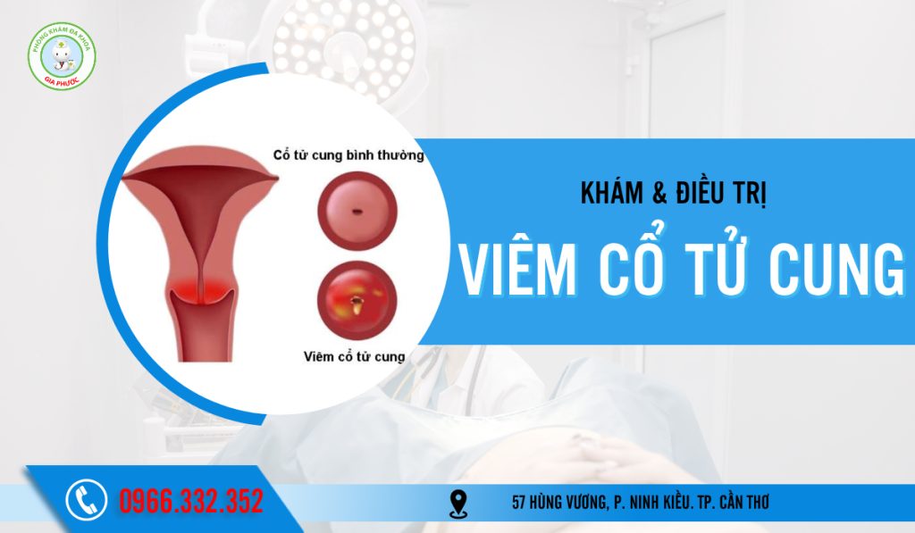 Tìm hiểu bệnh viêm cổ tử cung là gì?
