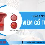 Giải Đáp Y Khoa: Viêm Cổ Tử Cung Là Gì? Dấu Hiệu Nhận Biết Và Cách Điều Trị Hiệu Quả 42 Tìm hiểu bệnh viêm cổ tử cung là gì?
