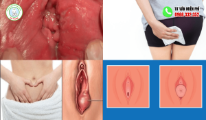 Bị lòi thịt ở cửa mình sau sinh