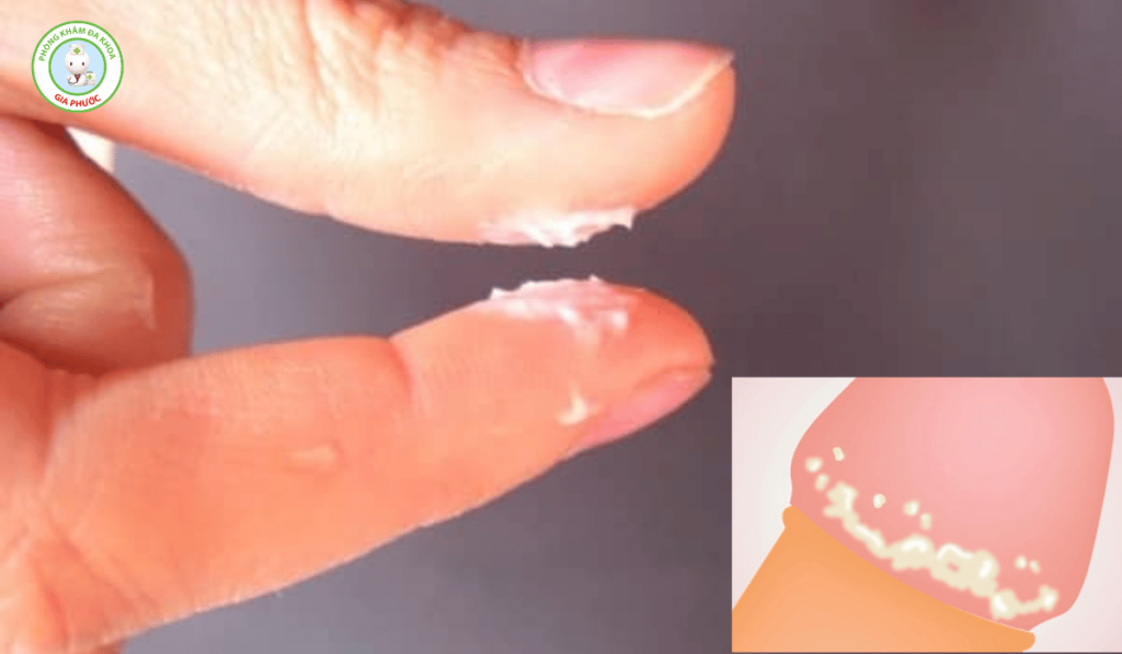 Bựa sinh dục là gì