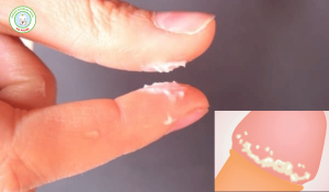 Bựa sinh dục là gì