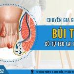 Giải đáp thắc mắc búi trĩ có tự teo lại không