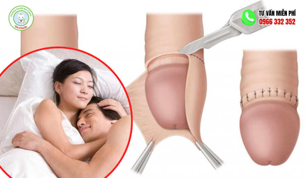 Cắt Bao Quy Đầu Bao Lâu Quan Hệ Được? Lưu Ý An Toàn 1 Cắt bao quy đầu bao lâu quan hệ được