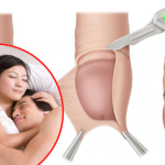Cắt bao quy đầu bao lâu quan hệ được