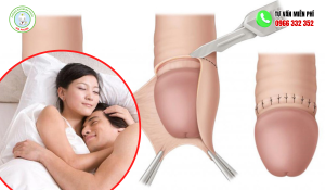 Cắt bao quy đầu bao lâu quan hệ được