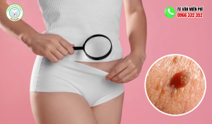 Chữa sùi mào gà hết bao nhiêu tiền