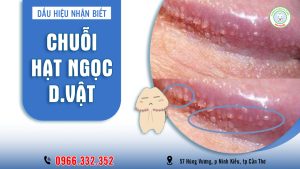 Chuỗi hạt ngọc dương vật bệnh gì?