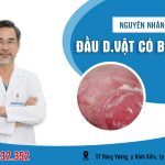 Đầu dương vật có bợn trắng