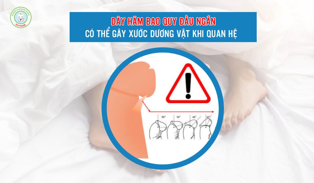 Dây hãm quy đầu ngắn là 1 trong những nguyên nhân gây xước dương vật khi quan hệ
