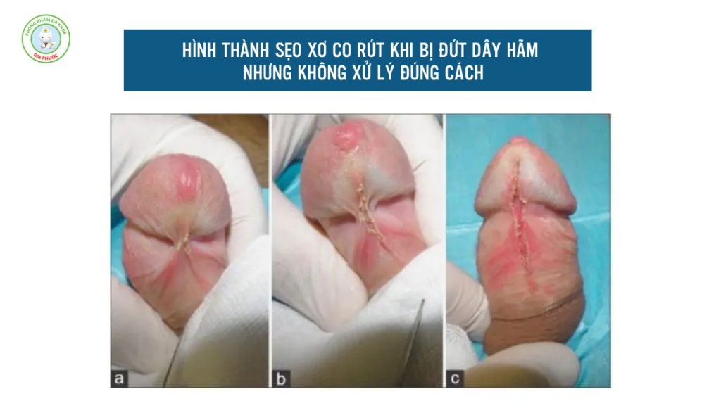 Đứt Dây Hãm Bao Quy Đầu Xử Lý Như Thế Nào An Toàn Chuẩn Y Khoa 4 Đứt dây hãm bao quy đầu nguy hiểm không?