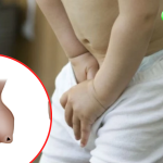 Hẹp bao quy đầu ở trẻ