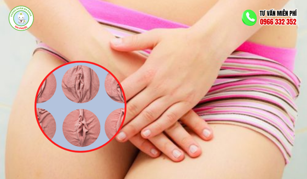 Hình ảnh âm vật bị lồi