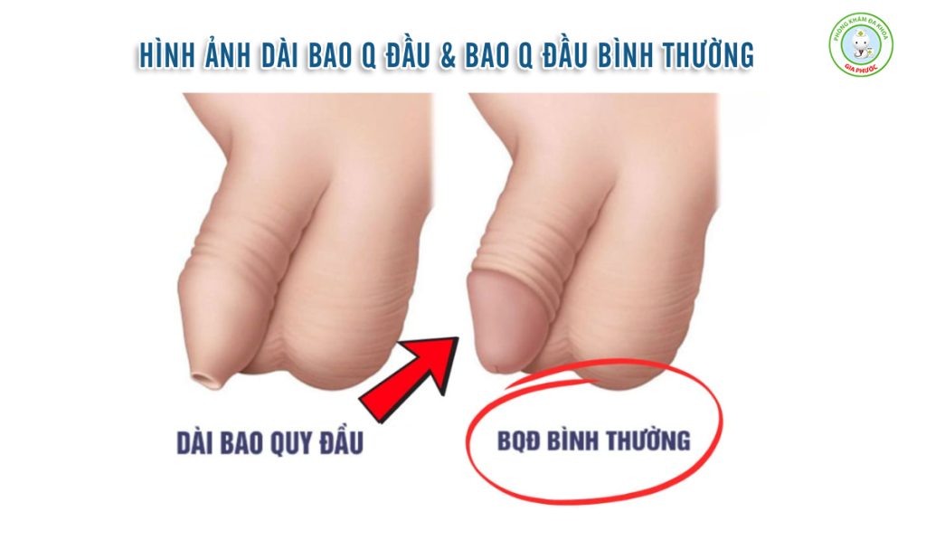 Thế Nào Là Bao Quy Đầu Bình Thường Và Bất Thường? Phân Biệt Chuẩn Y Khoa 2 Hình ảnh bao quy đầu bình thường và dài bao quy đầu