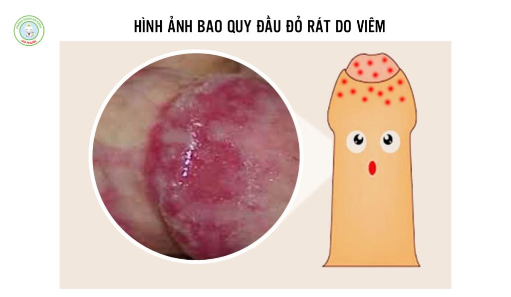 Bao Quy Đầu Bị Đỏ Rát Là Bị Gì? Nguyên Nhân & Cách Trị Hiệu Quả 2 Hình ảnh bao quy đầu đỏ rát do viêm nhiễm bao quy đầu