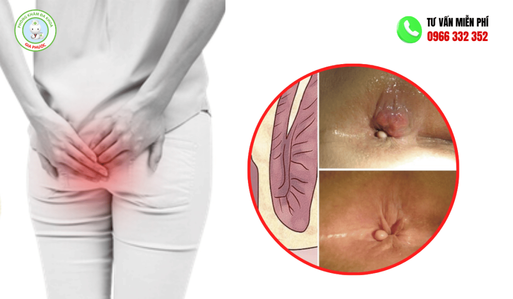 Bệnh Lòi Dom Là Gì? Hình Ảnh, Có Tự Khỏi Không Và Cách Chữa 2 hình ảnh bệnh lòi dom