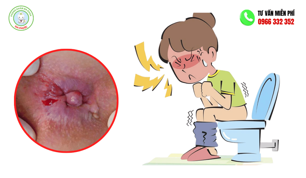 Bệnh Lòi Dom Là Gì? Hình Ảnh, Có Tự Khỏi Không Và Cách Chữa 4 hình ảnh bệnh lòi dom