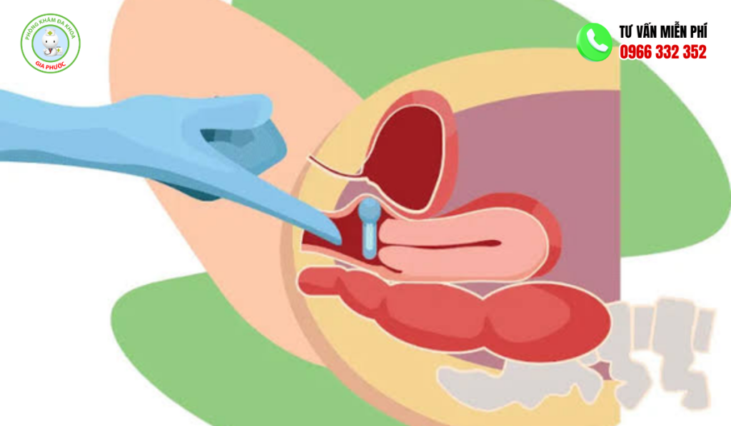 hình ảnh bị lòi thịt ở cửa mình sau sinh