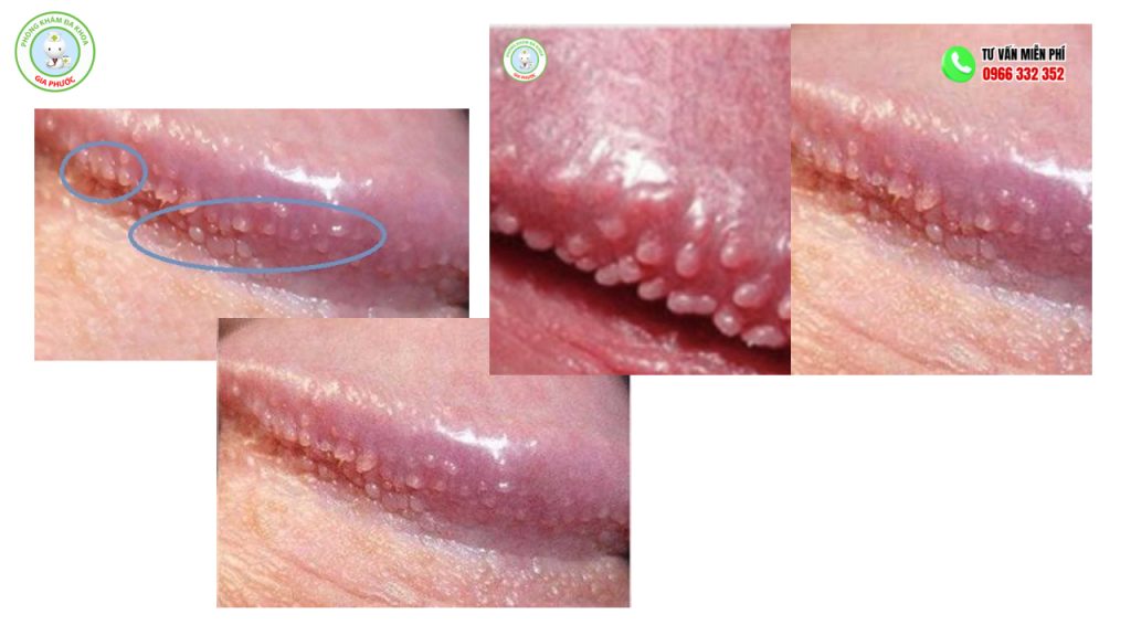Hình ảnh chuỗi hạt ngọc dương vật ở nam