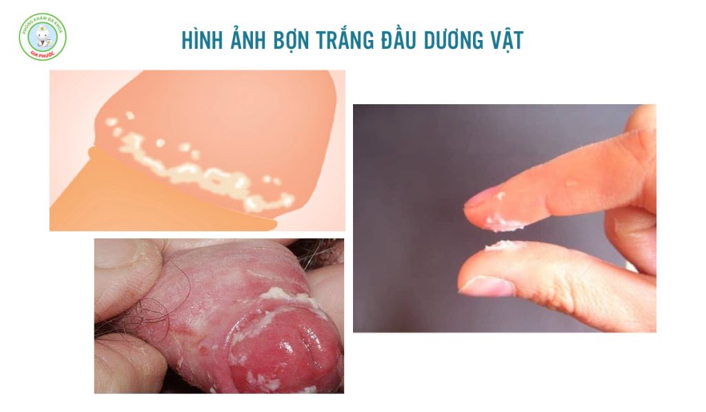 Hình ảnh đầu dương vật có bợn trắng