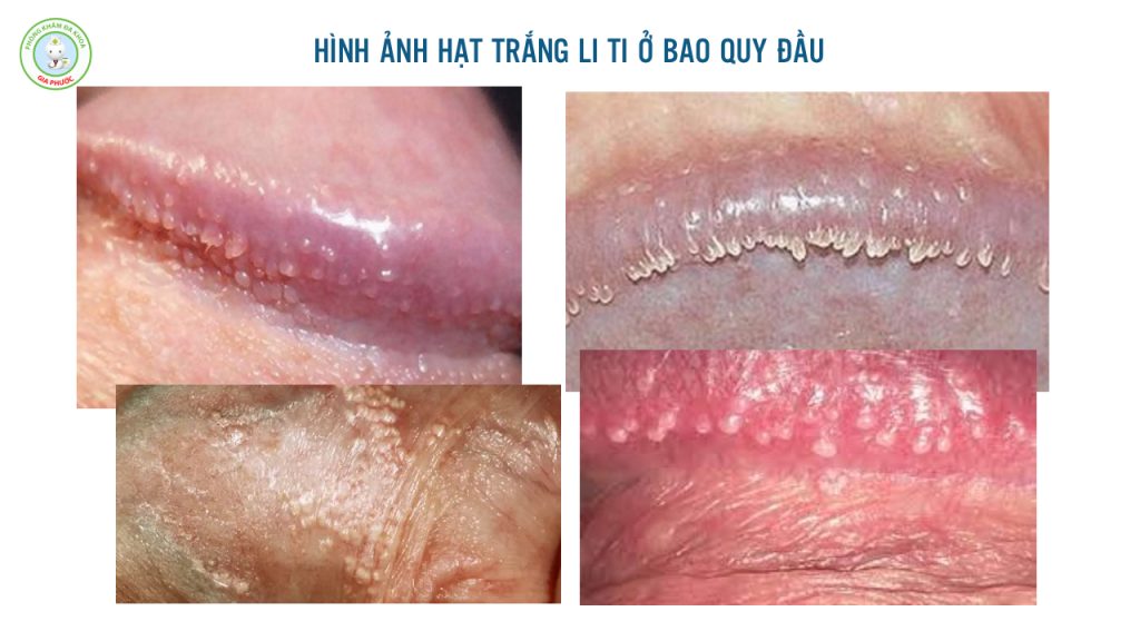 Hạt Trắng Li Ti Ở Bao Quy Đầu Bệnh Gì Và Cách Xử Lý Dứt Điểm Chuẩn Y Khoa 2 Hình ảnh hạt trắng li ti ở bao quy đầu